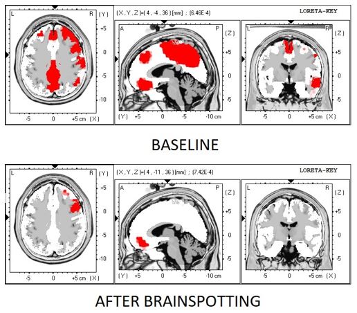 ADDING BRAINSPOTTING TO YOUR NEUROFEEDBACK PRACTICE