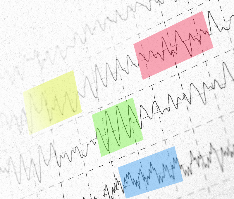 DECIPHERING EEG PHENOTYPES ONLINE CLASS RECORDING